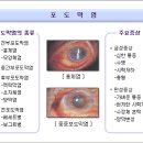 포도막염 이미지