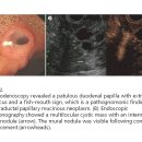 췌관 내 유두상 점액종양 이미지