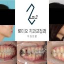 로미오치과교정과치과의원 네이버블로그