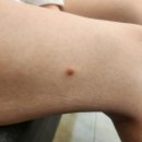 유성대학약국 | 허벅지 섬유종 제거 수술 후기 (대학병원 비용·흉터 관리 포함)