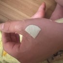 연세기쁨정형외과의원 | 화상 치료 후기 - 수원 화상치료 병원, 새솔외과의원 후기, 연세광교정형외과의원 후기- 화상 치료 기간...