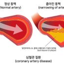 혈관 50% 막혀도 무증상.. 갱년기에 무서운 ‘이 병’은? 이미지