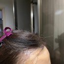 모더함의원 | [여성모발이식]4화 _4일째 울퉁불퉁 누리딩딩 사건 발생!