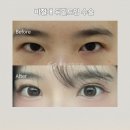 훌륭성형외과의원 | 강남 쌍꺼풀 수술 후기 절개법 훌륭성형외과 후기