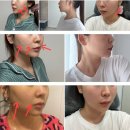 땅콩형얼굴 계란형으로, 병점피부과 리볼르(쥬베룩볼륨) 내돈내산 후기