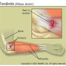 Tendinitis(건염)와 tendinosis(건병증)의 차이점 이미지