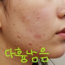 진실약국 | 애크논크림 약국 가격 사용법 500만원 쓰고 알게 된 진실
