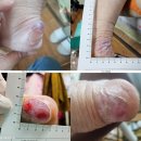 저온 화상 치료 후기