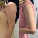 눈에띄다 | 구월동피부과 전문의 팔뚝 지방분해주사 효과 1회차 후기