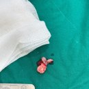 백점성형외과의원 | 모기질종 제거 수술 후기 비용 가격 정보