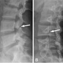 척추분리증과 척추 전방전위증 이미지