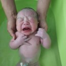 하얀멍이 | 12개월 아기 멜라니모반제거 후 스테리후기.