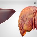 음식과 질환 - 간경변증 이미지