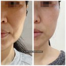 [ 부산 포텐자 ] 부산진구 서면피부과에서 피부관리로 받은 포텐자 콜라스터 스킨부스터