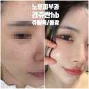 노원짱인형shop | 노원피부과 리쥬란hb 쥬베룩 물광주사 전후사진 내돈내산 파워후기