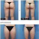 확실한 결과를 원하신다면 마이스터지방흡입을 선택하세요 이미지