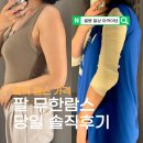 팔뚝 람스 당일 후기 전후 비교! 지방추출주사(+멍, 붓기, 통증)