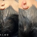 색을 입히다 | 텅 빈 정수리에 디자인을 입히다: 명동·충무로·동대문 나들이 겸 다녀온 두피문신 솔직 후기