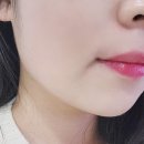 수함요새 | 홍대역 피부과 볼뉴머 편리하고 안전한 케어