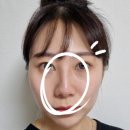 대구동성로피부과 코필러 내돈내산 보정 없는 전후 사진 후기