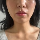 대구 달서구 월성동 피부과 '베러미의원' 슈링크 300샷 후기 (통증, 일주일 후)