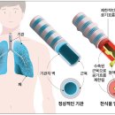 유병률 3%대…젊은층 점차 증가세 천식의 영양관리 ＜1＞ 이미지