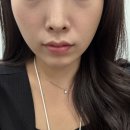 페이스 | 강남역 피부과 얼굴라인 정리되는 튠페이스 후기