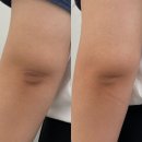 피플라 | 피플라 본사 플라즈마교육 | 대구 달서구 팔꿈치 색소침착 흑꿈치 탈출 팔꿈치케어 솔직후기