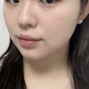 명동목욕탕 | 명동 을지로입구역 피부과 온다리프팅 5만줄, LDM&amp;비타민 수액까지(외국인 피부과 추천)