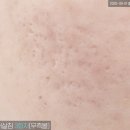 방학동 피부과, 방학역 한의원 박스형 송곳형 복합 여드름 흉터 치료 후기(새살침 6회)