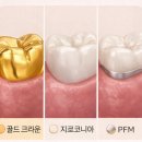 FIT치과기공소 | 크라운 보철 가격 50만 원 날리기 싫다면 꼭 보세요