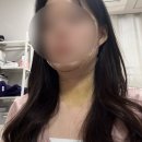 근육친구 | 부산서면 이중턱지방흡입, 근육묶기 수술 내돈내산 후기(남자, 여자) | (한달이후 후기까지)