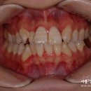 서울 가지런이 치과교정과 치과의원 | 심각한 덧니 치료는 교정전문치과 선택이 중요!