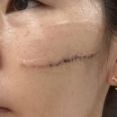 한땀성형외과의원 | 고양이에게 할퀸 얼굴, 정자동 한땀성형외과에서 흉터 거의 사라졌어요 (솔직 후기)
