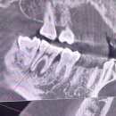 바다치과기공소 | 급성 치수염 치료과정 엑스레이 통증 진통제 (2) 인생 첫 신경치료를 받다