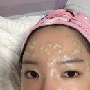 브라이트피부과의원 | 피부과] 가심비 미쳐버린 병점역 초대형 피부과 '리베리의원' 화성병점점에서 편평사마귀 지지고 온 후기