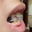 [준이 교정일기] 준이의 치아교정 두 번째 후기!!! / 아인스치과에서 돌출입교정 발치 안하기로 하고...