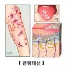 태선