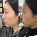 하도탐나 | [서울/압구정]압구정로데오피부과 온다리프팅 후기 웨딩 시술 효과