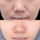 오창 에스테틱 오로라뷰티 톤업 광채 케어 후기, 잡티 고민이라면 닝톡톡케어