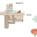 요로결석 후기 이미지