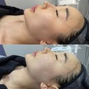 천안 불당동 뷰티에이 '인퓨즈웨이브' 후기 l 얼굴 근육 운동으로 턱라인 실종 탈출!