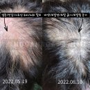 도봉/창동 탈모관리 모발생장술 블래스유