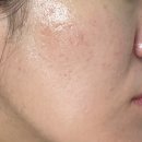 차한의원 | 노원피부과추천 한의원 여드름 흉터 시술 4회차 후기