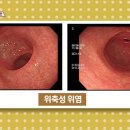위암의 가능성이 높은 위염 종류.jpg 이미지