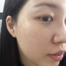 미소지움피부과의원 | [피부변천사] 송도 피부과 추천 미소지움피부과 여드름, 잡티, 주근깨, 기미, 홍조 해결끝!