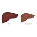 브니엘요양병원 | [양평/양평군 요양병원/브니엘 노인전문병원] [소화기계 질환] 간경화