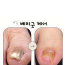베리굿케어울산내성발톱무좀