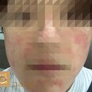 고일약국 | 모공과 주름개선 레이저 포텐자, 쥬베룩 얼마나 아플까? 솔직 후기