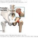 힘든 고관절통증 어떻게 할까요? 고관절 통증을 일으키는 이미지